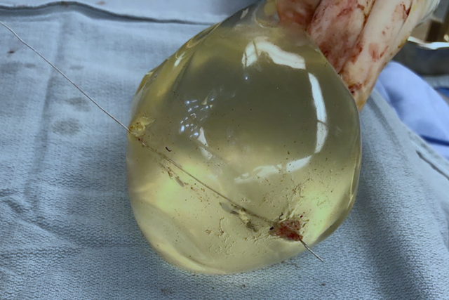 Intraoperative view of left breast implant showing bullet trajectory through implant