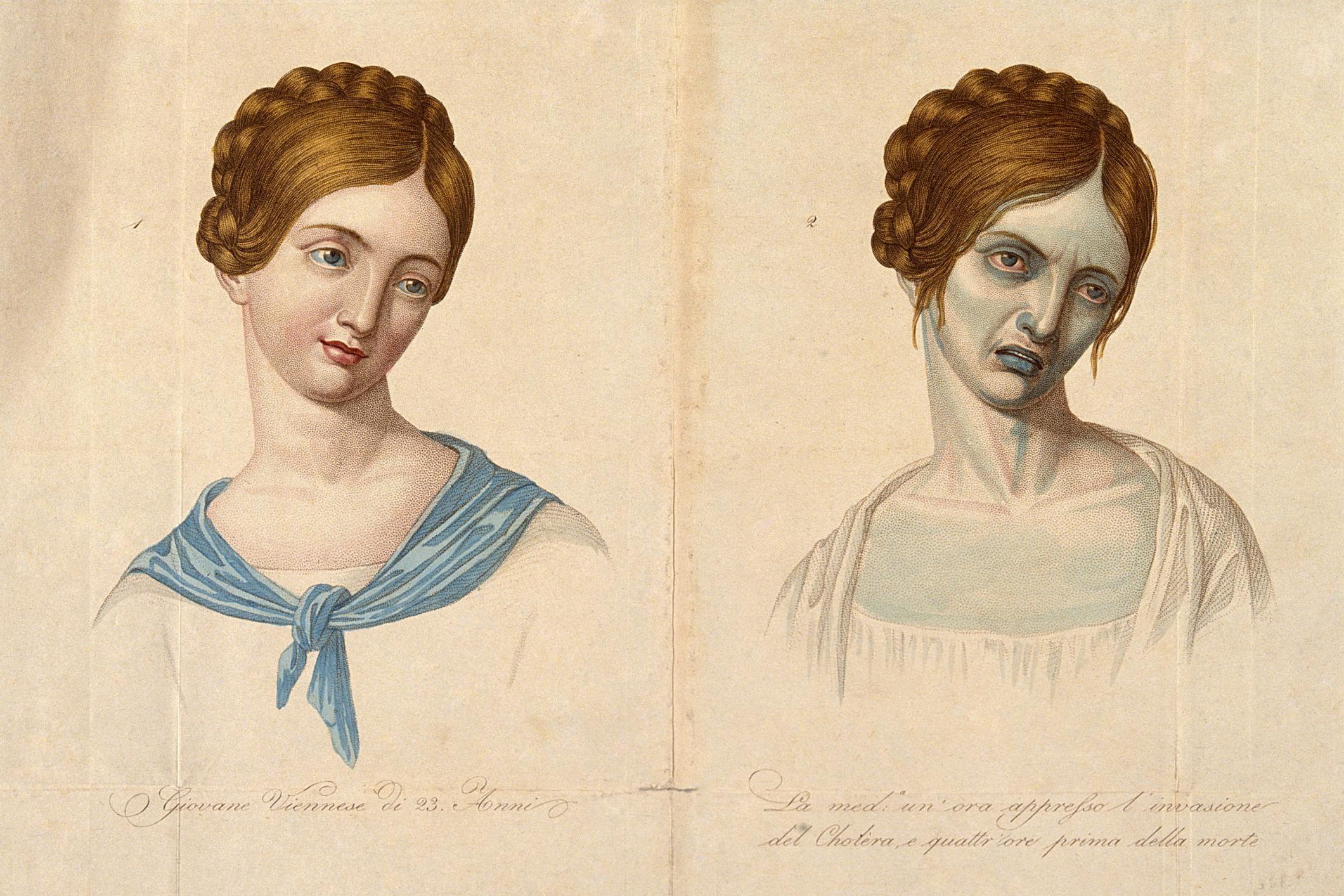 Before and after shot: an illustration depicting a woman who died from cholera