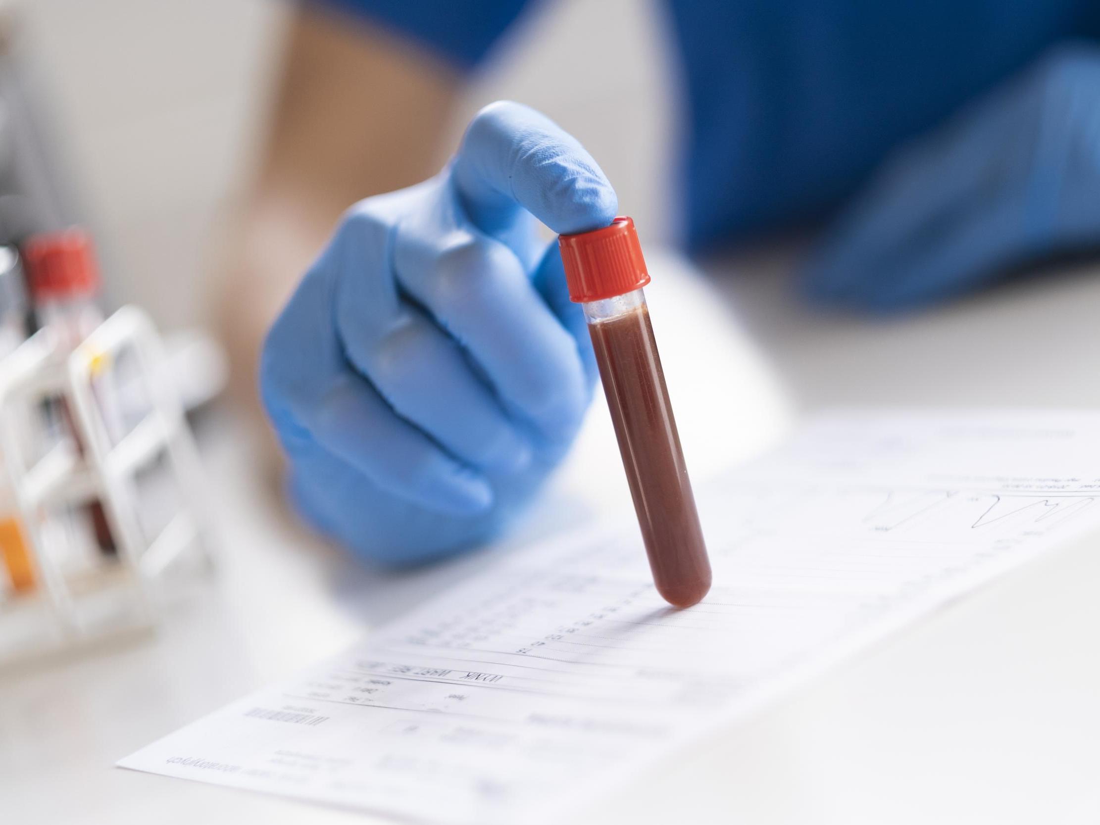 Prostate cancer: Blood test could predict how well patients will respond to treatment, research suggests thumbnail
