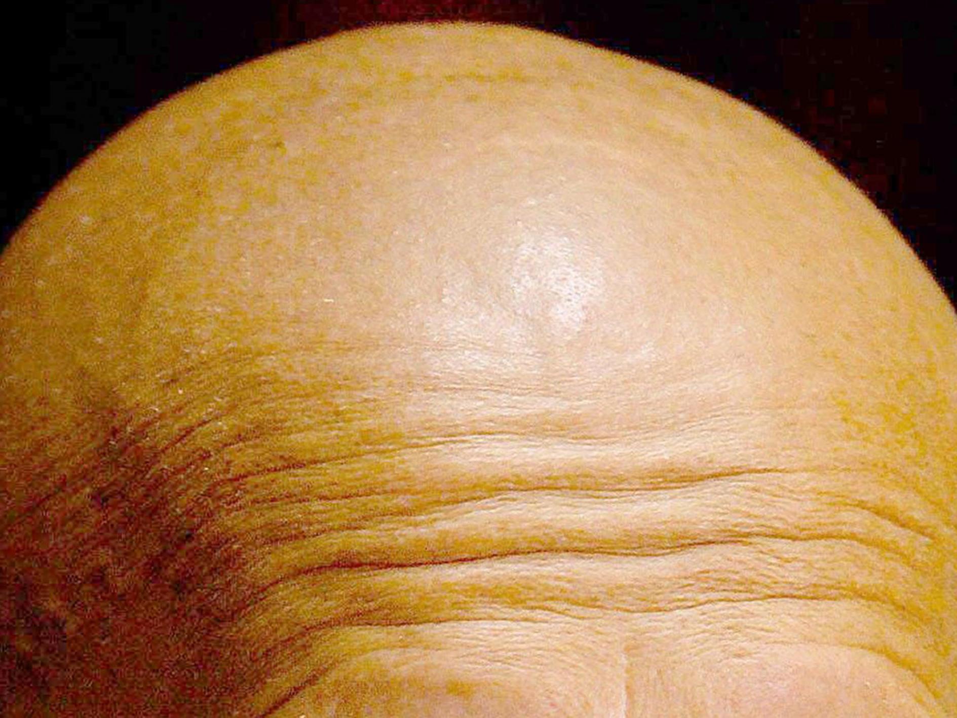 New research has suggested that baldness may increase the risk of developing severe coronavirus symptoms.