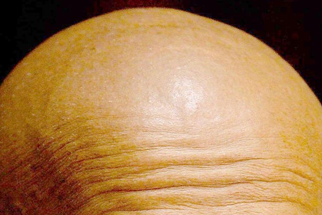 New research has suggested that baldness may increase the risk of developing severe coronavirus symptoms.