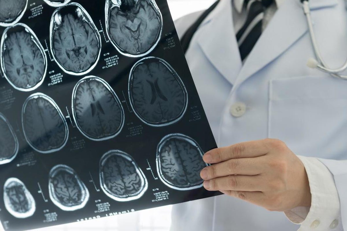 Brain tumour drug with remarkable trial results won’t be available on NHS