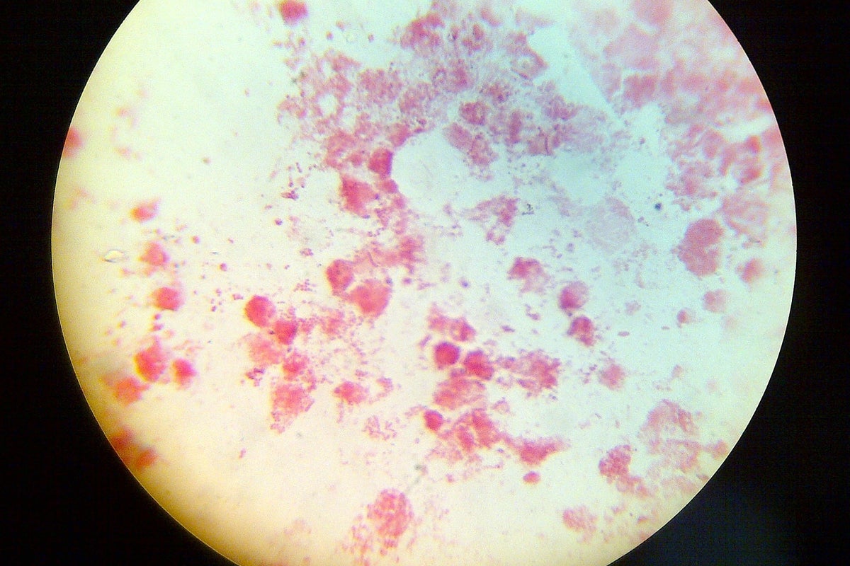 Gonorrhea and syphilis cases hit record highs in Europe due to changing sexual habits and testing