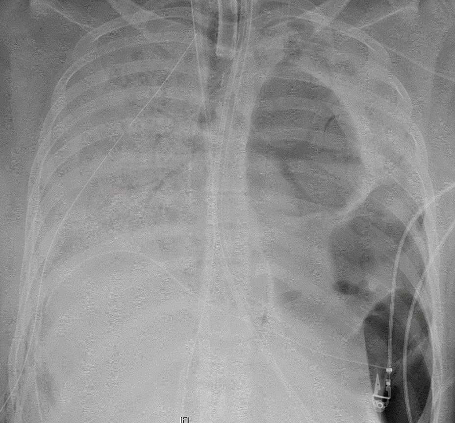 An X-ray of a Covid-19 patient’s lungs