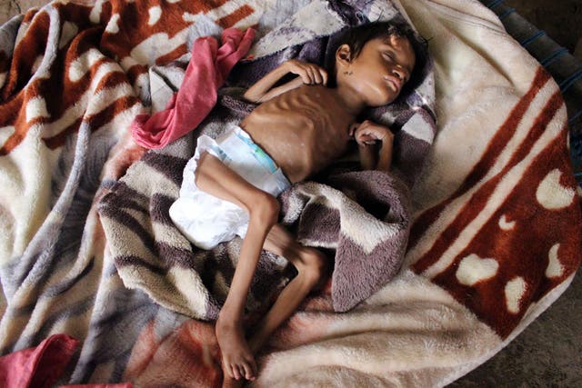 Salwa Ibrahim, a five-year-old girl suffering from acute malnutrition and weighing 3kg, sleeps on a bed inside an improvised house in Yemen's northern Hajjah province