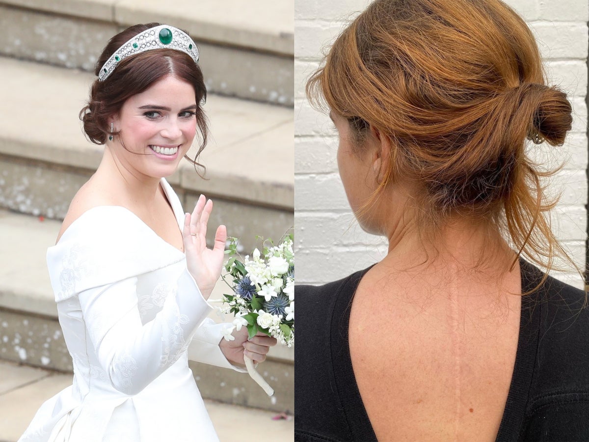 princess eugenie scoliosis wedding dress Princess Eugenie's wedding dress highlights scoliosis scars