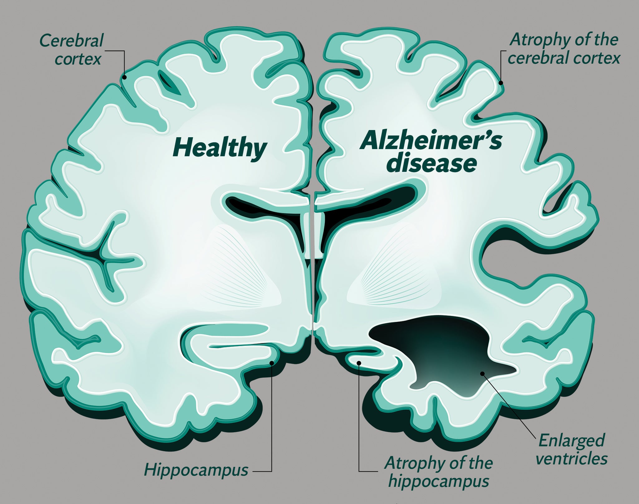 The hippocampus is especially sensitive to oxygen loss