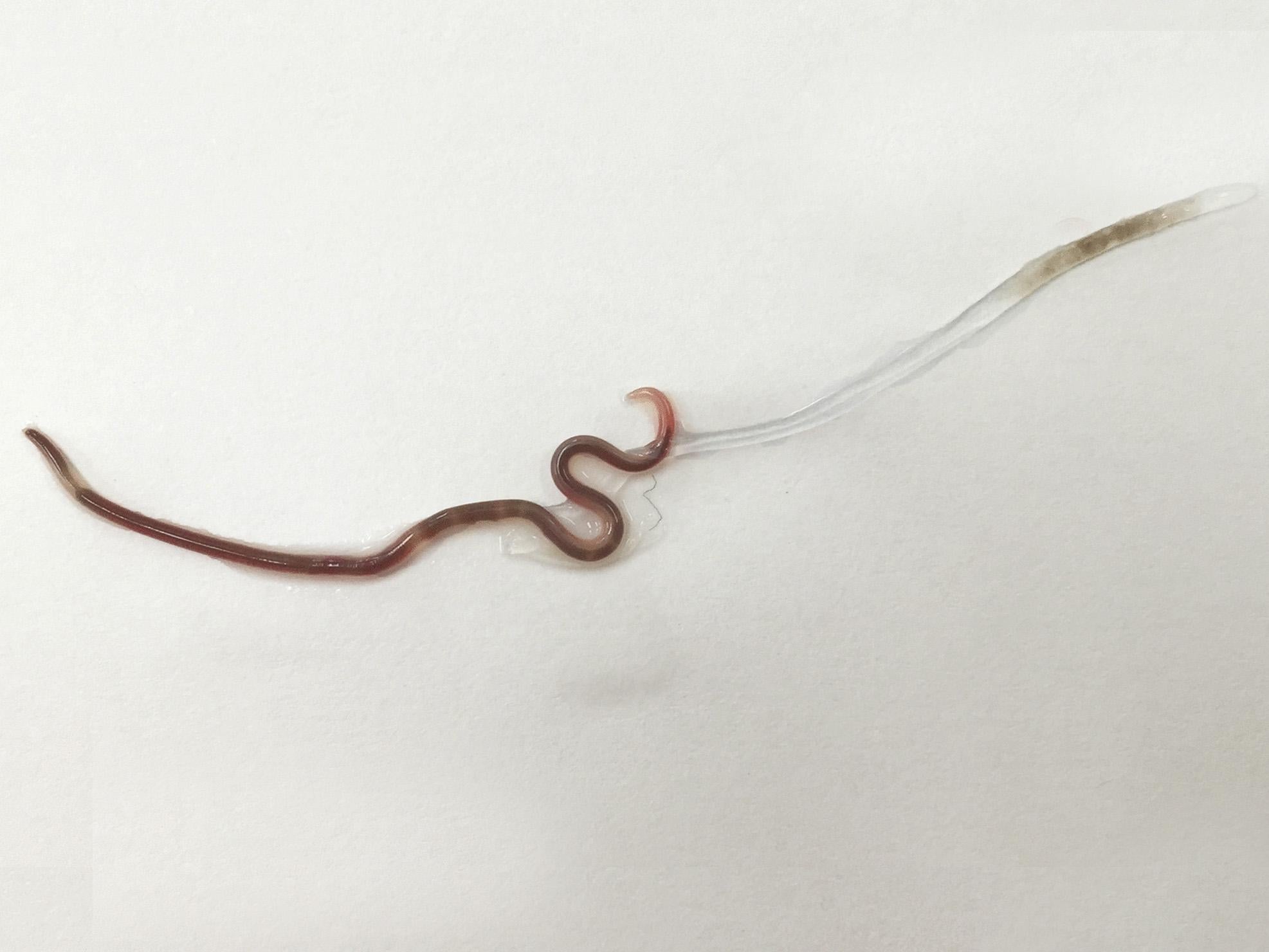 Worm found living in woman's tonsil for nearly a week, The Independent