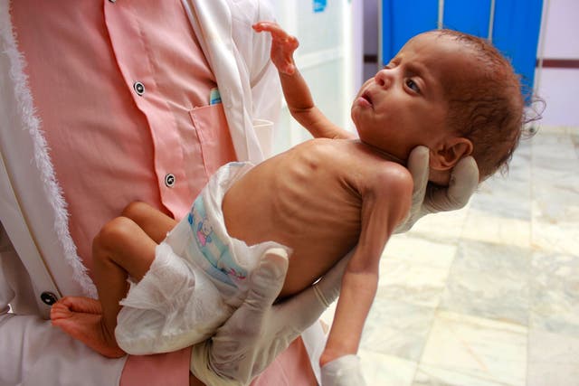 A medical care worker holds a Yemeni child suffering from malnutrition at a treatment centre in Yemen's northern Hajjah province