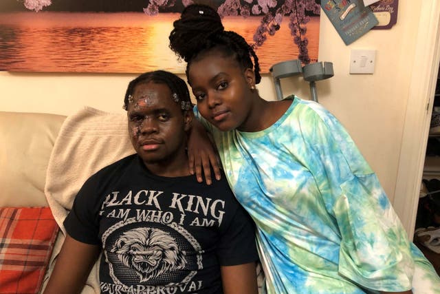 Kdogg, pictured at home with his sister, will be scarred for life following a racist hit-and-run attack