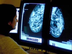 Breast cancer screening for women in their 40s ‘could save lives’