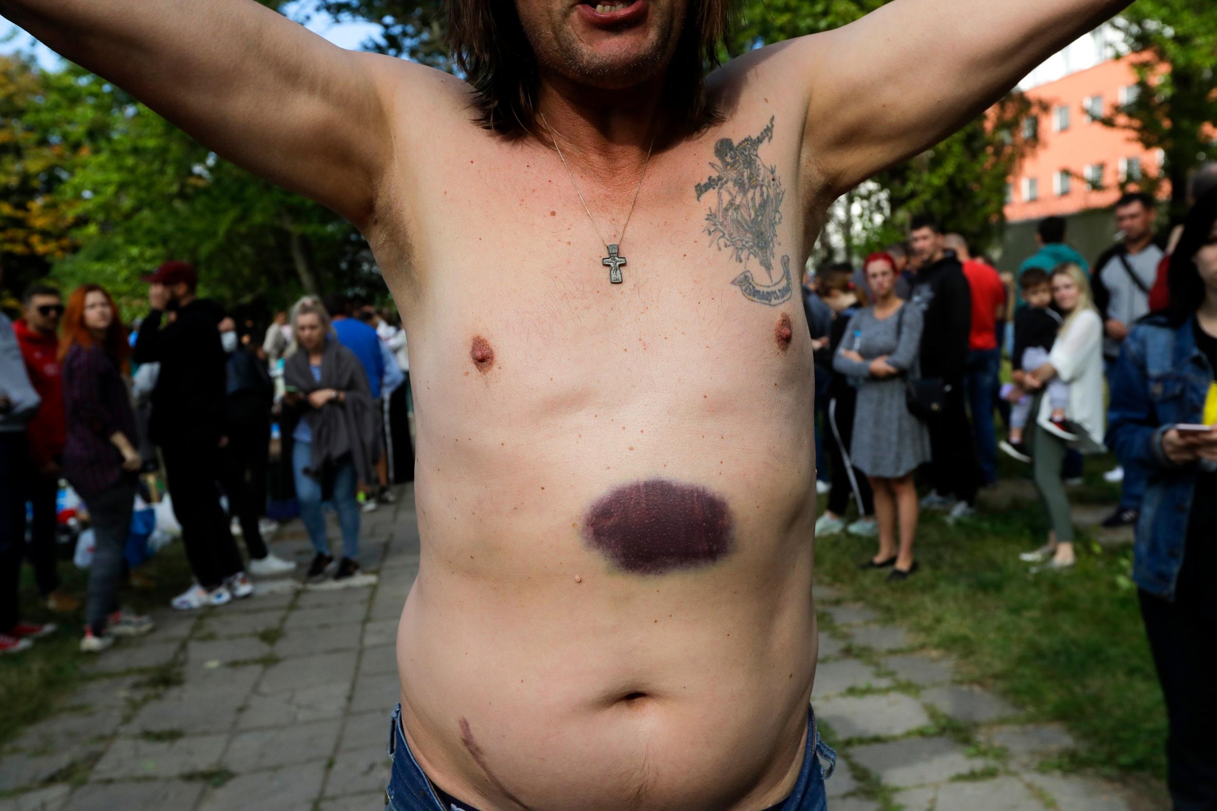A man shows bruises he says were left by police beating after being released from a detention centre
