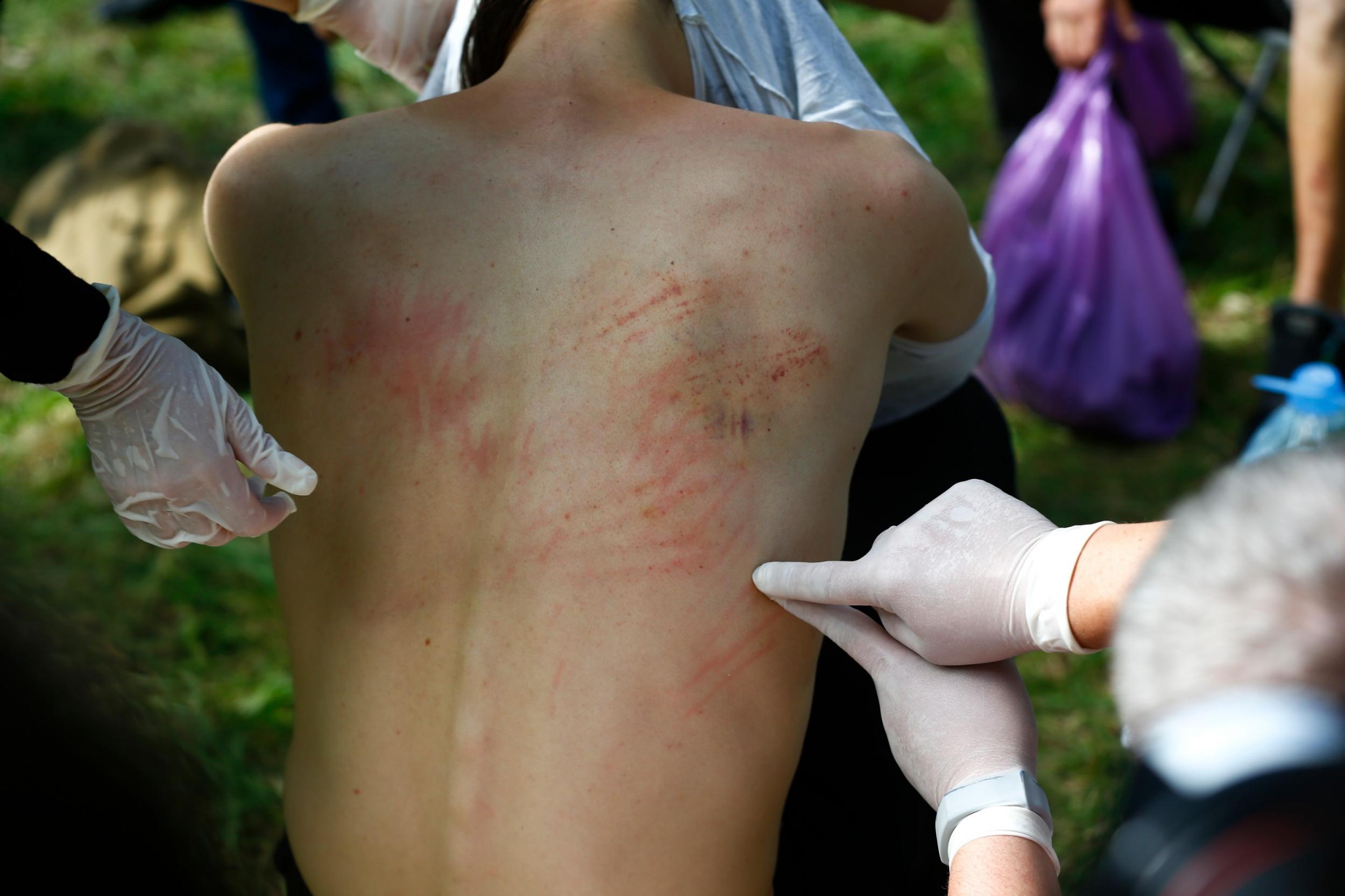 A man shows marks on his body he says are from a police beating after being released from a detention centre