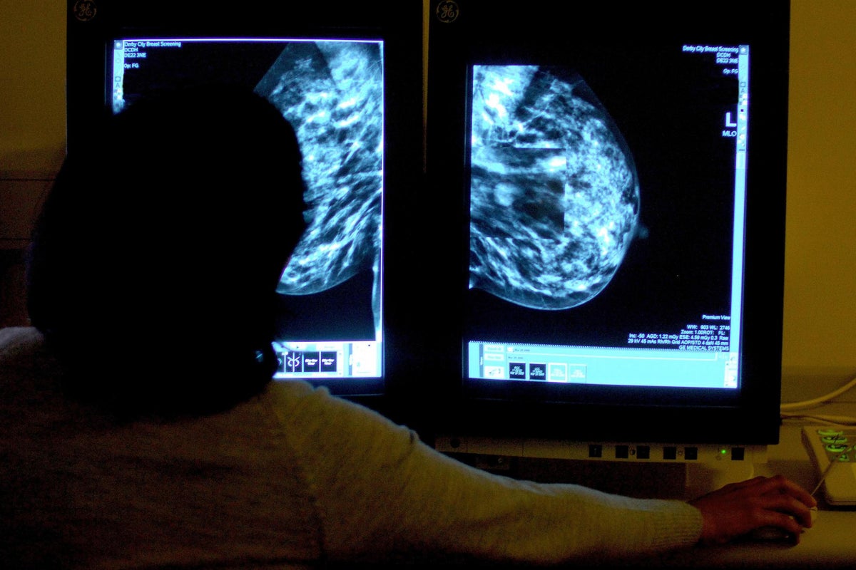 Unlikely treatment linked with longer survival in breast cancer study